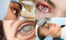 Katarakt Ameliyatı ile İlgili Lens Seçenekleri Nelerdir?