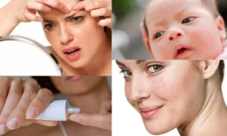 Aknelerin Oluşum Nedenleri