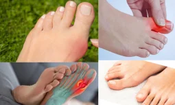 Başparmak Çıkıntısı Kaderiniz Olmasın: Benim İyileşme Hikayem