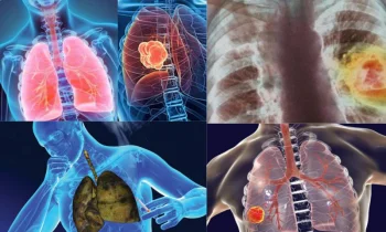 Akciğer Kanseri Yaşam Süresi Ne Kadardır?