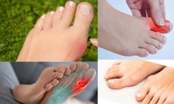 Başparmak Çıkıntısı Kaderiniz Olmasın: Benim İyileşme Hikayem