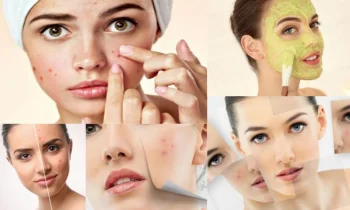 Sivilcelerden Kurtulmak İçin Neler Yapılabilir?